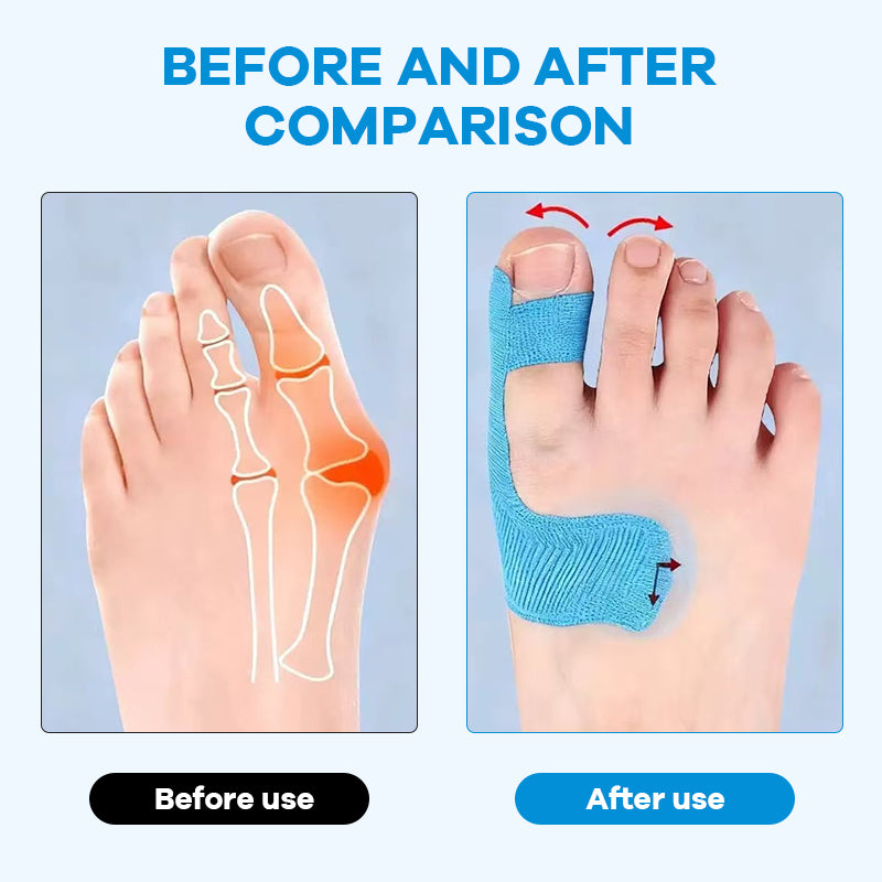 Voorgesneden kinesiologietape voor hallux valgu